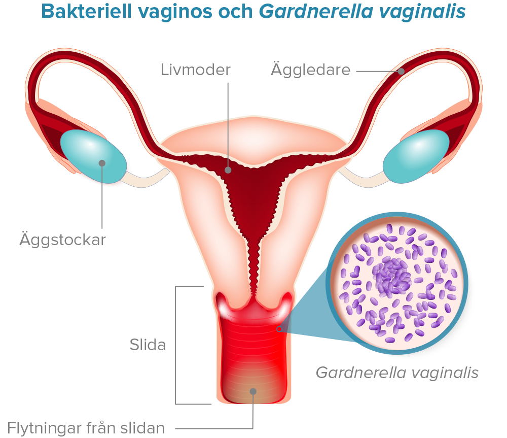 Bakteriell vaginos och Gardnerella vaginalis Diagram.