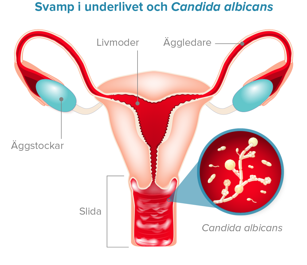 Svamp i underlivet och Candida albicans Diagram.